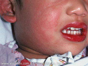 5 how old to lower in year fever Kawasaki Disease