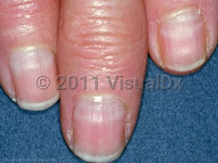 arsenic poisoning fingernail signs
