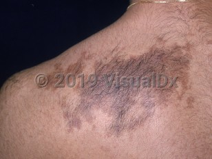 spina bifida hair patch