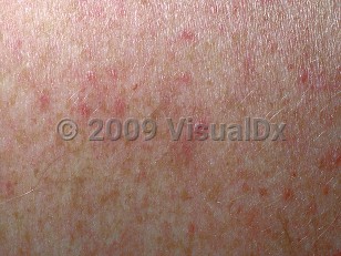 dengue hemorrhagic fever rash