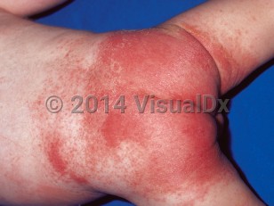 perianal streptococcal dermatitis