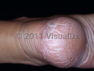 fissure skin
