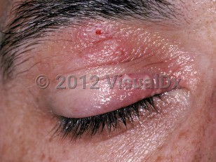 herpes simplex under eye