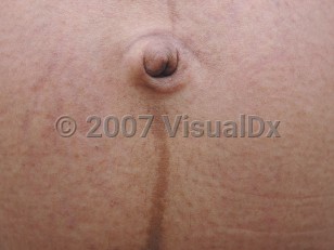 File:Cesarean section scar and linea nigra.JPG - Wikipedia