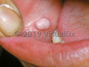 Oral Fibroma