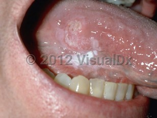 early squamous cell carcinoma mouth