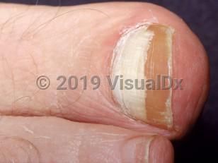 distal and lateral subungual onychomycosis