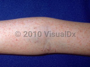rocky mountain spotted fever rash dog