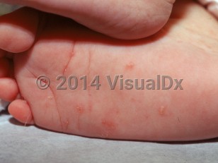 scabies burrows