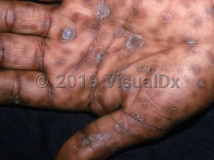 Syphilis Rash l Signs and Symptoms