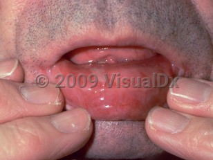 mucous membrane pemphigoid mild