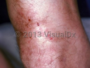 Clinical image of Dermatitis herpetiformis - imageId=117824. Click to open in gallery.  caption: 'A close-up of excoriated papules and vesicles near the knee.'