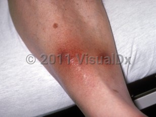 Clinical image of Pancreatic panniculitis - imageId=153599. Click to open in gallery.  caption: 'Purpuric nodules with surrounding erythema on the lower shin.'