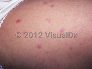 Clinical image of Aplastic anemia - imageId=1559435. Click to open in gallery.  caption: 'Purpuric macules on the thigh.'