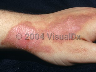 Clinical image of Fire coral sting - imageId=2201820. Click to open in gallery.  caption: 'Pink geographic plaques and surrounding light brown patches on the dorsal hand.'