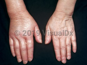 Clinical image of Thromboangiitis obliterans - imageId=2221719. Click to open in gallery.  caption: 'Edema of the right hand and fingers (early edematous phase).'
