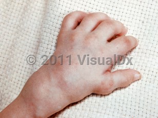 Clinical image of Farber disease - imageId=2366528. Click to open in gallery.  caption: 'Subcutaneous nodules and masses over the joints of the hand and wrist.'