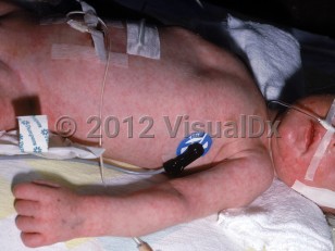 Clinical image of Argininosuccinic aciduria - imageId=2376924. Click to open in gallery. 