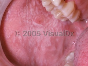 Clinical image of White sponge nevus of the oral mucosa - imageId=2499571. Click to open in gallery.  caption: 'A large furrowed, white plaque on the buccal mucosa.'