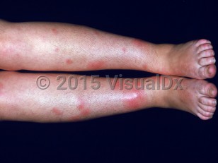 Clinical image of Ulcerative colitis - imageId=2527215. Click to open in gallery.  caption: 'Widespread erythematous nodules on the shins and feet.'