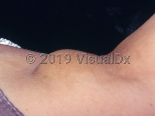 Clinical image of Accessory breast tissue - imageId=2799551. Click to open in gallery.  caption: 'A subcutaneous mass in the axilla.'