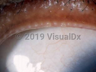Clinical image of Meibomitis - imageId=2840028. Click to open in gallery.  caption: 'Prominent tiny papules at the eyelid margin.'