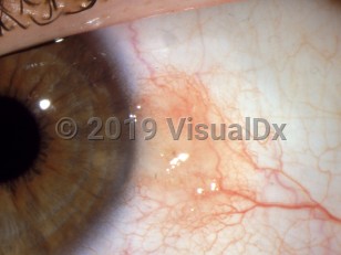 Ophthalmic Imaging image of Conjunctival nevus - imageId=2889663. Click to open in gallery.  caption: 'Tiny brown papule on the bulbar conjunctiva.'