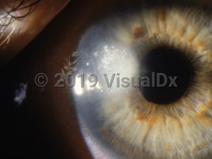 Ophthalmic Imaging image of Fungal corneal ulcer - imageId=2891581. Click to open in gallery. 