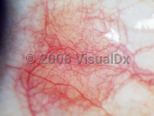 Ophthalmic Imaging image of Diffuse episcleritis - imageId=2892296. Click to open in gallery. 