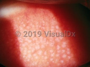 Ophthalmic Imaging image of Giant papillary conjunctivitis - imageId=2893823. Click to open in gallery.  caption: 'Myriad faint pink-white papules (papillae) on the pretarsal conjunctiva of the upper eyelid.'