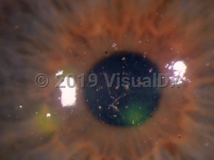 Ophthalmic Imaging image of Corneal abrasion - imageId=2911612. Click to open in gallery. 