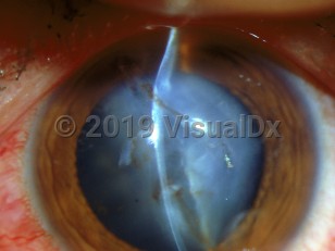 Ophthalmic Imaging image of Corneal laceration - imageId=2916608. Click to open in gallery. 