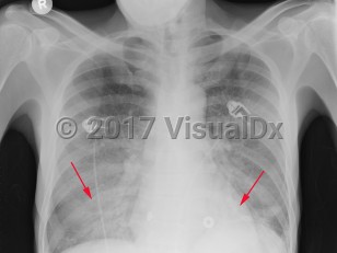 Imaging Studies image of Pneumocystis jirovecii pneumonia - imageId=2956223. Click to open in gallery.  caption: 'Frontal chest x-ray with diffuse, bilateral ground glass opacities with progression to air space consolidation, worse in the lower lobes.'