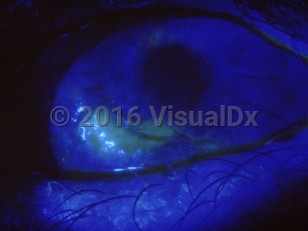 Ophthalmic Imaging image of Trichiasis - imageId=3077120. Click to open in gallery.  caption: 'A corneal abrasion secondary to trichiasis.'