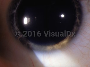 Ophthalmic Imaging image of Wilson disease - imageId=3083243. Click to open in gallery. 