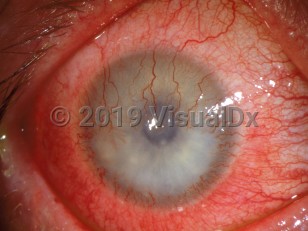 Ophthalmic Imaging image of Corneal neovascularization - imageId=3089395. Click to open in gallery. 