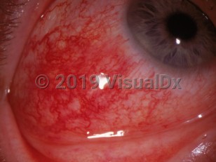 Ophthalmic Imaging image of Diffuse scleritis - imageId=3103267. Click to open in gallery. 