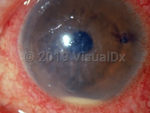 Ophthalmic Imaging image of Bacterial corneal ulcer - imageId=3104703. Click to open in gallery. 