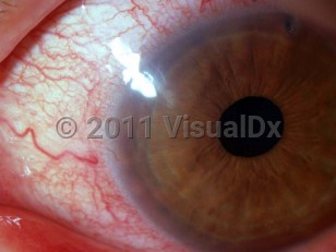 Ophthalmic Imaging image of Contact lens solution toxicity - imageId=3144398. Click to open in gallery. 