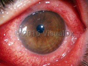 Ophthalmic Imaging image of Gonococcal conjunctivitis - imageId=3193274. Click to open in gallery. 