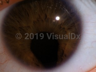 Ophthalmic Imaging image of Coloboma - imageId=3203913. Click to open in gallery. 