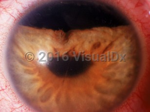 Ophthalmic Imaging image of Hyphema - imageId=3239674. Click to open in gallery. 