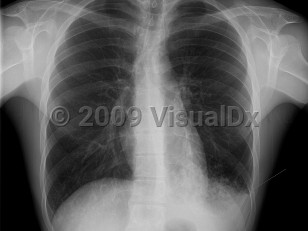 Imaging Studies image of Influenza - imageId=4025949. Click to open in gallery. 