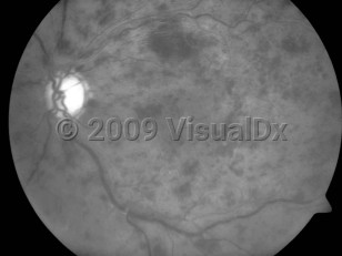 Ophthalmic Imaging image of Central retinal vein occlusion - imageId=4174932. Click to open in gallery. 