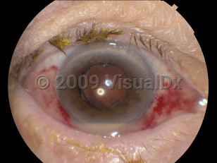 Ophthalmic Imaging image of Endophthalmitis - imageId=4379327. Click to open in gallery. 