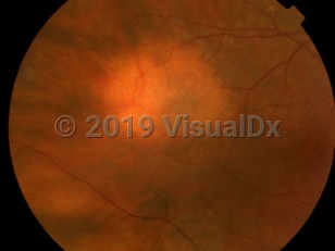 Ophthalmic Imaging image of Choroidal nevus - imageId=4537664. Click to open in gallery.  caption: 'An amelanotic choroidal nevus, appearing as a hypopigmented patch.'