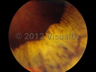 Ophthalmic Imaging image of Retinopathy of prematurity - imageId=4538015. Click to open in gallery. 