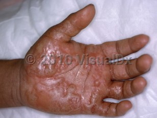 Clinical image of Ammonia and sulfur dioxide burns - imageId=4565951. Click to open in gallery.  caption: 'Extensive vesicle and bulla formation, some clear and some cloudy, on the palm and fingers, secondary to ammonia.'