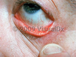 Clinical image of Blepharitis - imageId=486428. Click to open in gallery.  caption: 'Conjunctival injection on the inner eyelid and eye and surrounding scaling and erythema.'