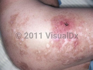 Clinical image of Leprosy-Lucio phenomenon - imageId=5291837. Click to open in gallery.  caption: 'An erythematous plaque with an overlying eschar and surrounding depigmented plaques with light brown haloes on the lateral thigh and buttock.'